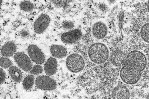 Elektronenmikroskopische Aufnahme, die von den Centers for Disease Control and Prevention zur Verfügung gestellt wurde, zeigt reife, ovale Affenpockenviren (l) und kugelförmige unreife Virionen (r), die aus einer menschlichen Hautprobe stammt. Foto: Cynthia S. Goldsmith/Russell Regner/CDC/AP/dpa